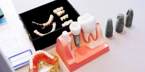 宁波种牙哪家医院好，宁波鼎植口腔医院口碑更好